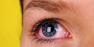 'Göz tansiyonu (glokom); belirti vermeye başladığında, yaklaşık yüzde 30-35 sinir hücresi kaybı olmuştur ve bu hücre kaybı, geri dönüşsüzdür'